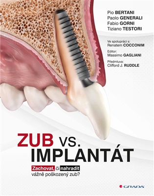 Zub vs. implantát